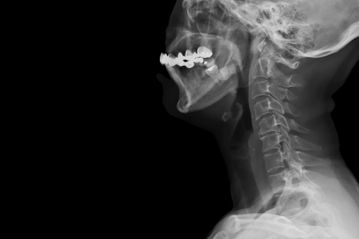 Cervical disc herniation: why early diagnosis is crucial